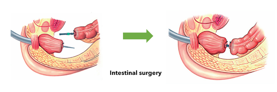 circular-stapler-Indication-REAL-changzhou-medical